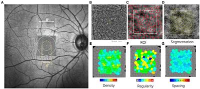 Reduced contrast sensitivity function is correlated with changes to cone photoreceptors in simple high myopia